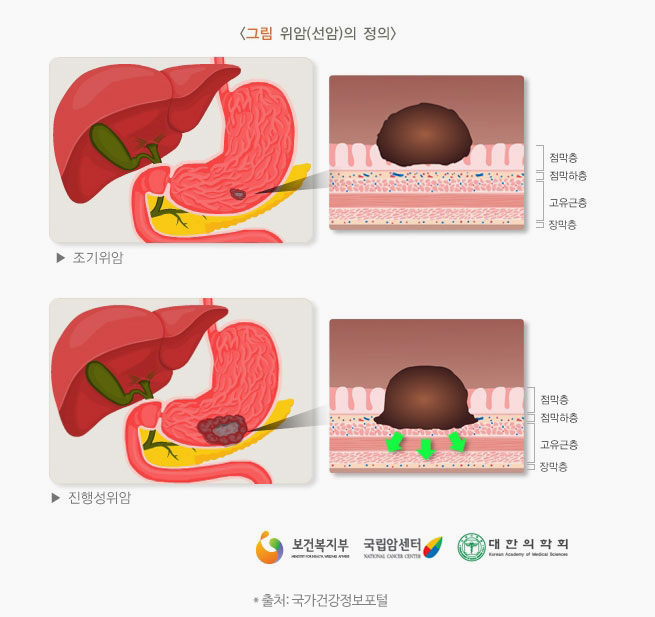 암의 원인