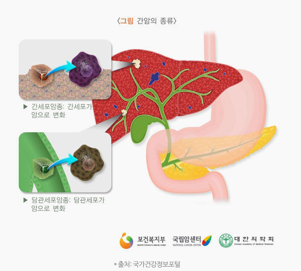 간암의 원인