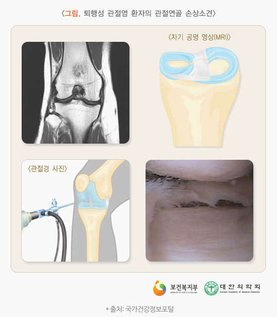 골다공증의 진단