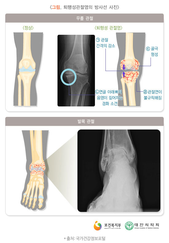 퇴행성 관절염