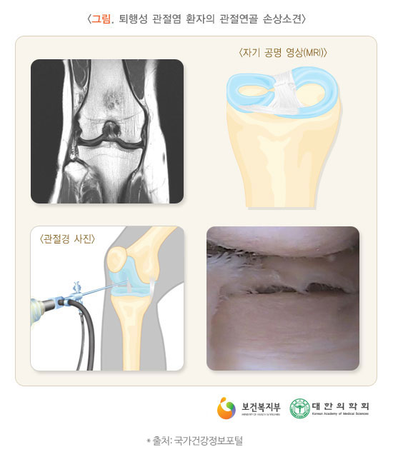 골다공증