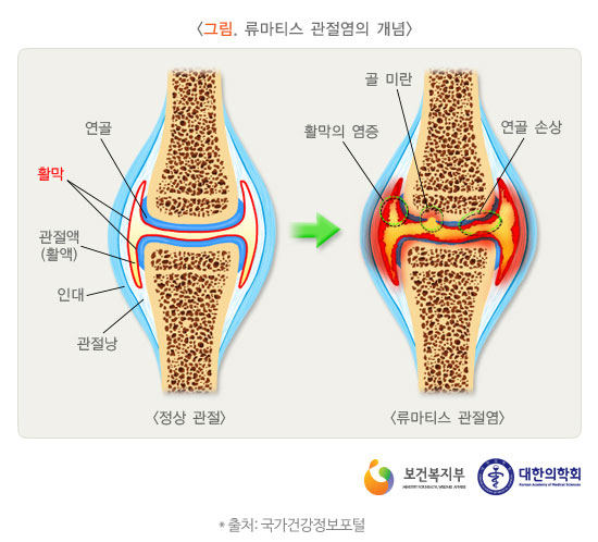 류마티즘 관절염