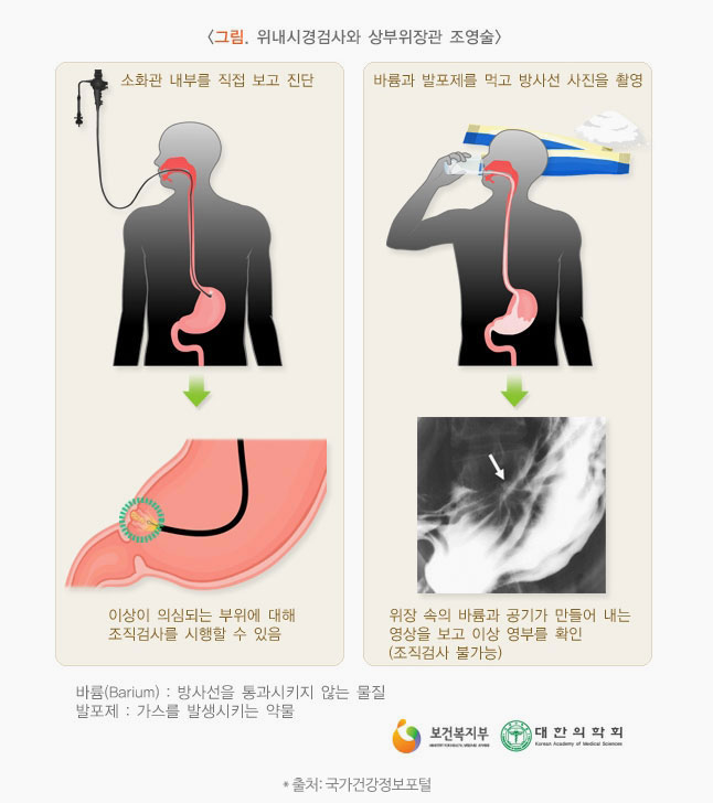 위 내시경검사와 상부위장관 조영술