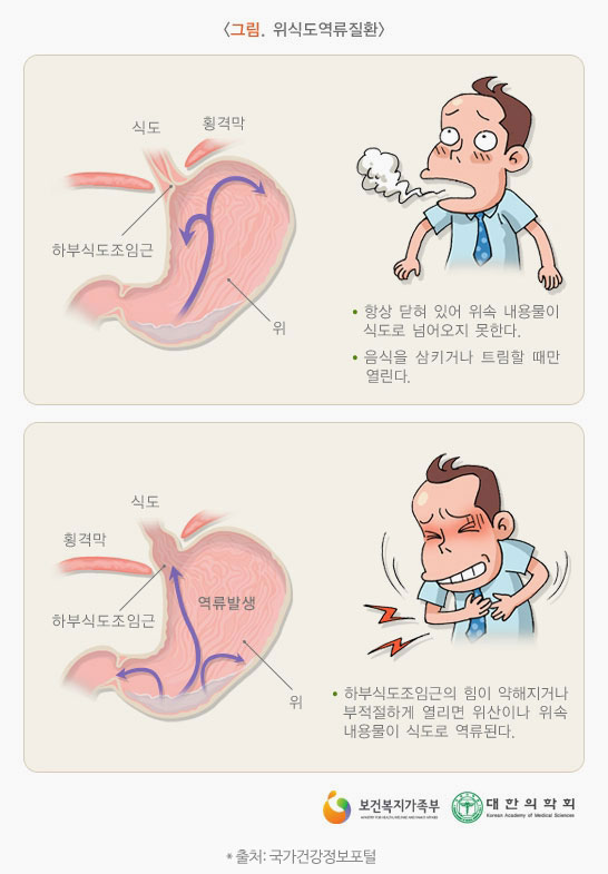 역류성 식도염의 증상